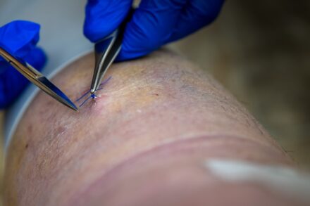 Acupuncture Surgeon is using tools to stitch a wound.