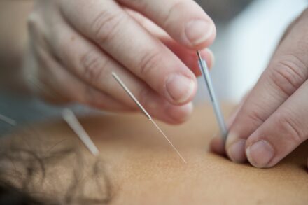 Acupuncture person holding silver and white pen