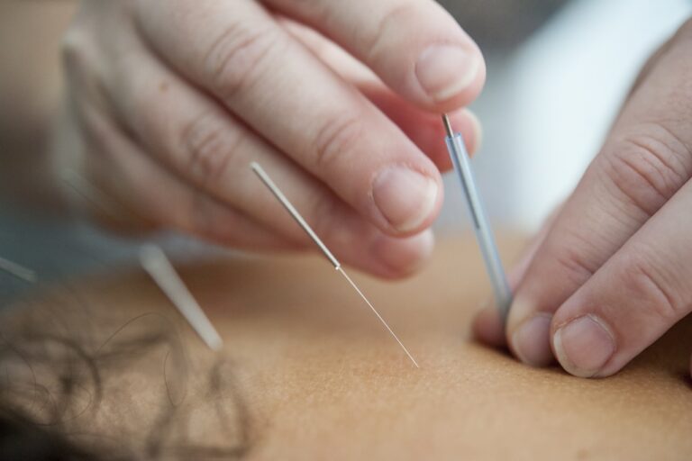 Acupuncture person holding silver and white pen